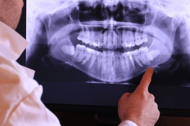 Best Emergency Wisdom Tooth Extraction in Kingsville, TX